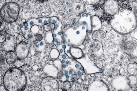 Parkinson'da Toksik Protein Birikimi Hedef Alındı